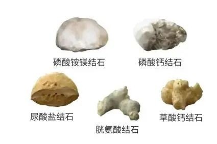 结石也分“门派”？成分不同，治法大不同！