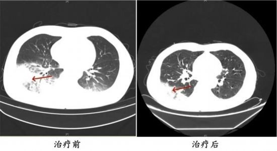 周先生治疗前后的肺部CT影像